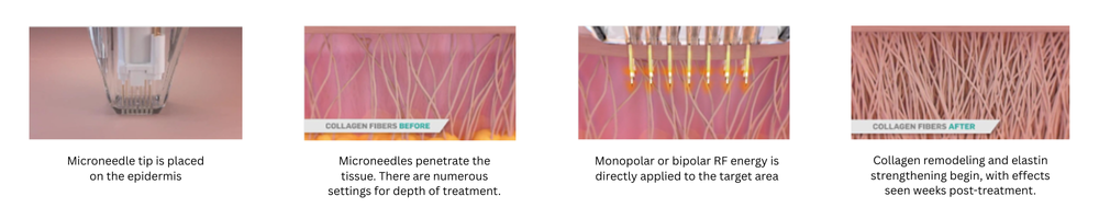 How Does Potenza RF Microneedling Work?
